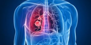 Lung Nodule Detection from CT Scan Using Intel Processors - Deck - White Paper